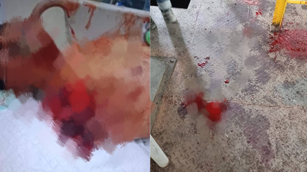 Tragedi Berdarah di KEK Sei Mangkei! Pekerja Boiler PT Sheel Oil Indonesia Mengalami Putus Tangan, Terancam Cacat Seumur Hidup