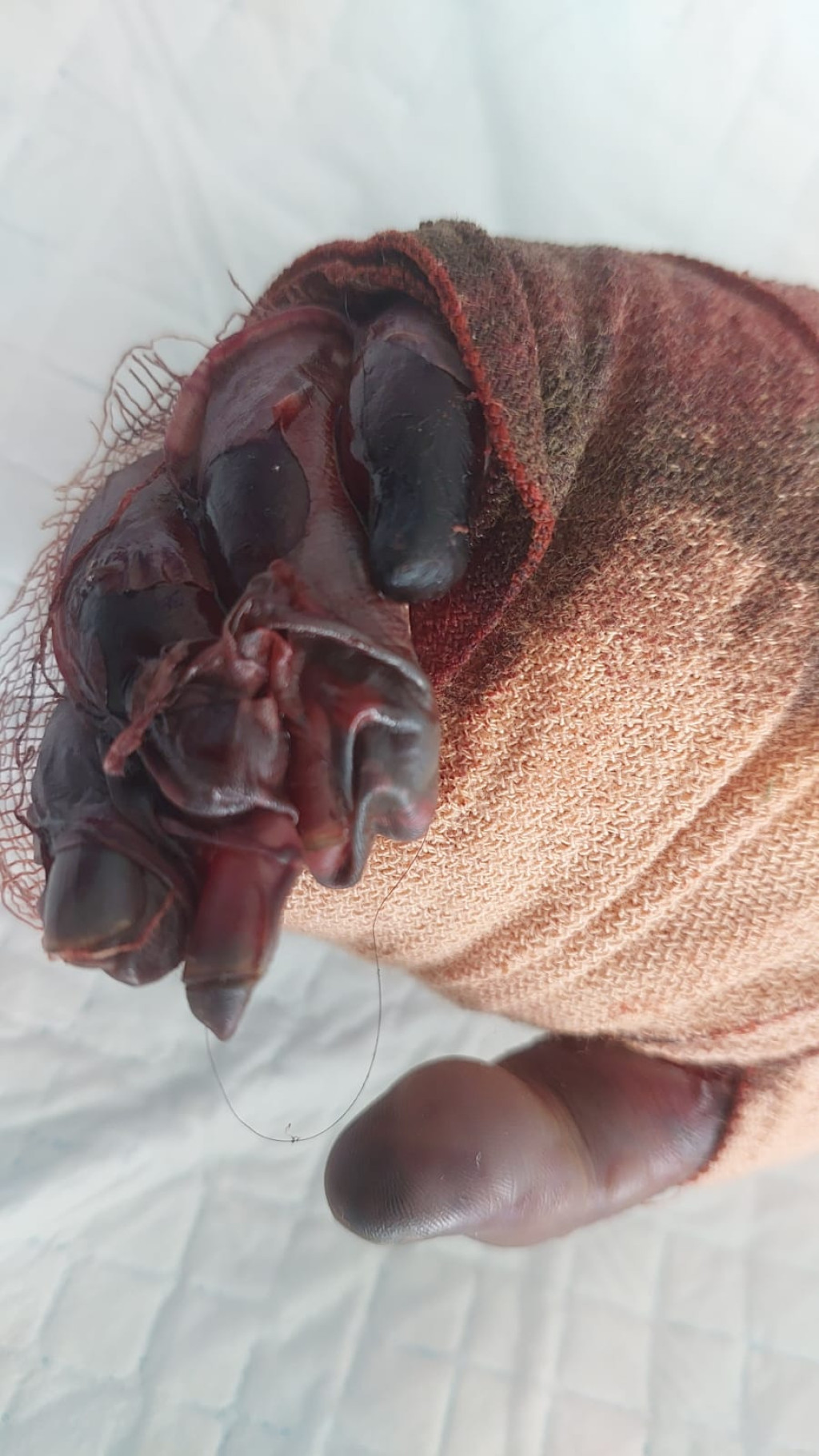 Diduga  Malapraktik Dokter di Rumah Sakit Permata Madina, Dari Awal Pasien Sakit Lambung, Berakhir Pasien Diaputasi