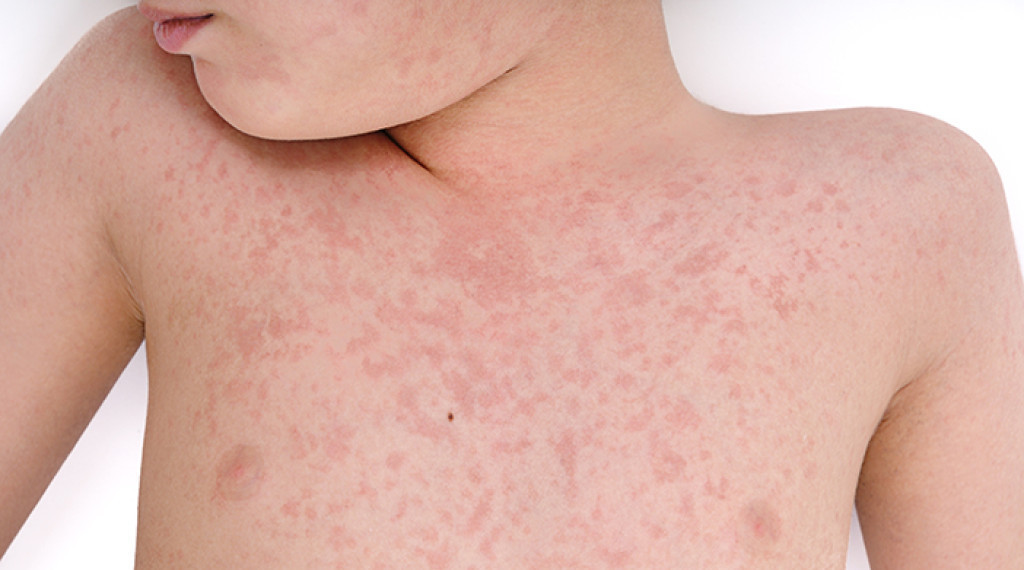 Kadis Kesehatan DKI Minta Warga Waspadai Penularan Campak Saat Silaturahmi Lebaran