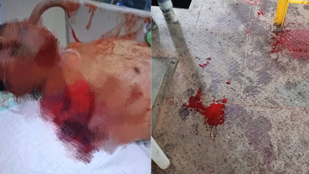 Tragedi Berdarah di KEK Sei Mangkei! Pekerja Boiler PT Sheel Oil Indonesia Mengalami Putus Tangan, Terancam Cacat Seumur Hidup