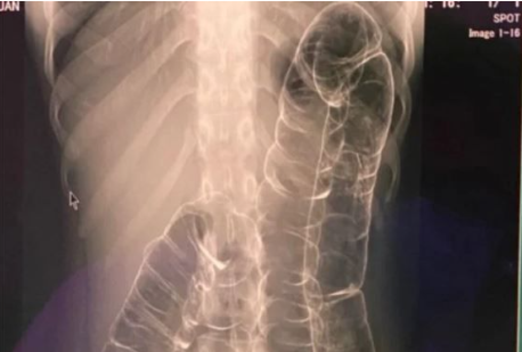 23 Tahun Tak Bisa BAB Normal, Hasil Rontgen Wanita Ini Bikin Dokter Terkejut: Usus Nyaris Sampai Jantung