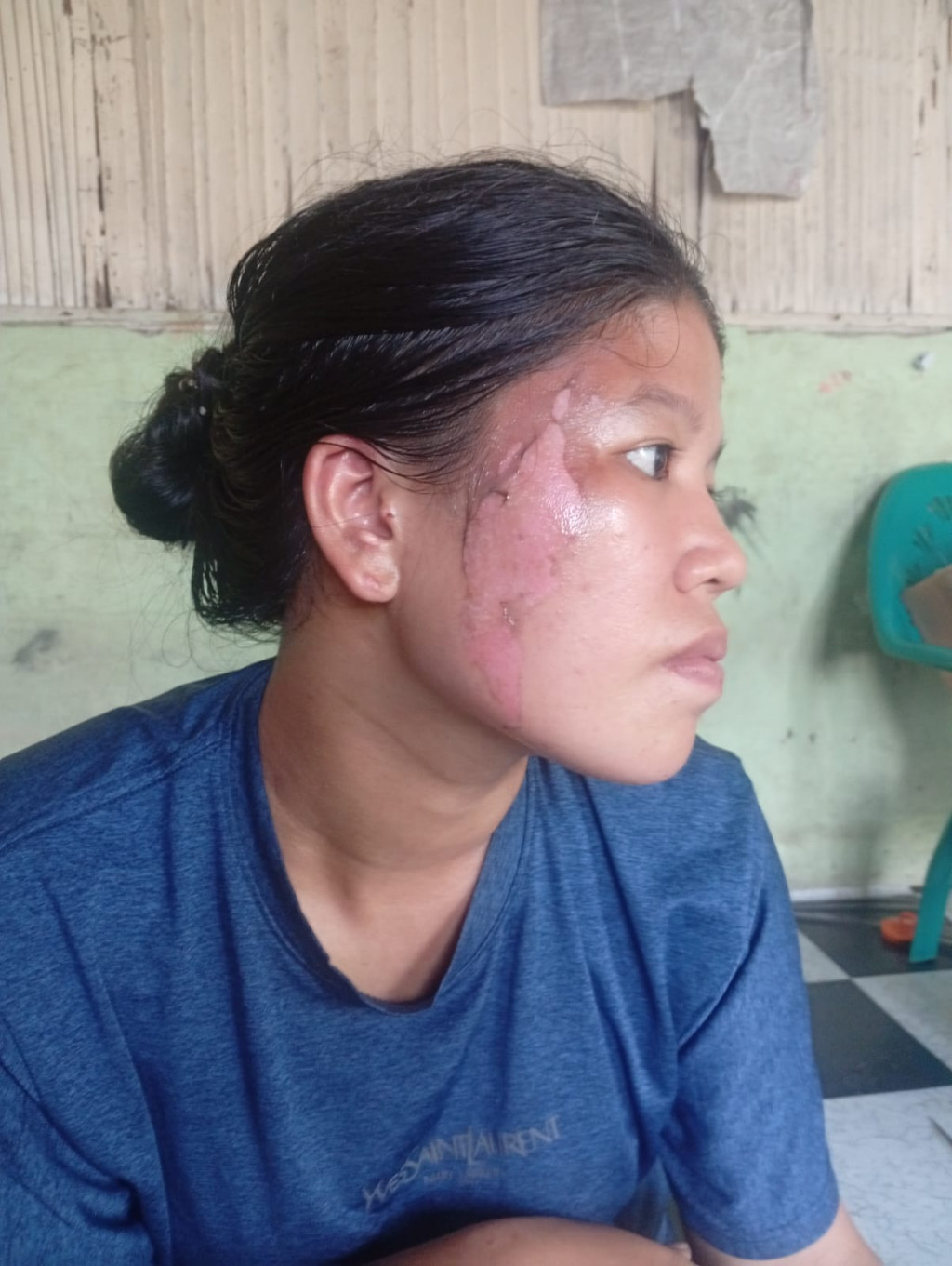 Sadis!! Dewi Disiram Air Panas Hingga Wajah Melepuh oleh Kawan Kerjanya
