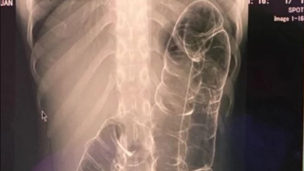 Viral Hasil Rontgen Usus Wanita Susah BAB di Vietnam, Mengerikan!