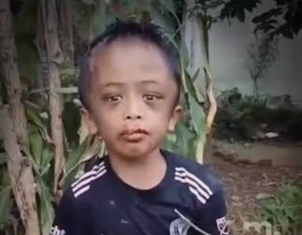 Bocah 7 Tahun Alvino Purba Disiksa di Sidikalang, Telinga Berdarah hingga Tangan Patah