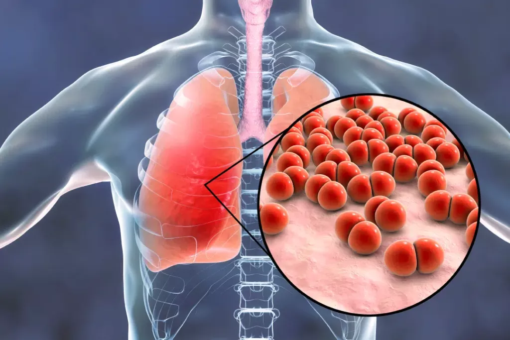 Ketua Satgas PAPDI: Komorbiditas dan Gaya Hidup Buruk Perparah Pneumonia Dewasa